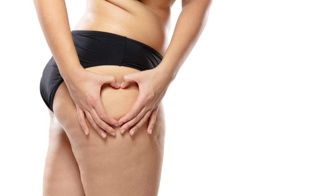 celulitis
